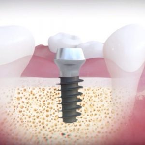 minimally invasive dental implant