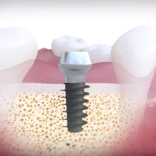 minimally invasive dental implant