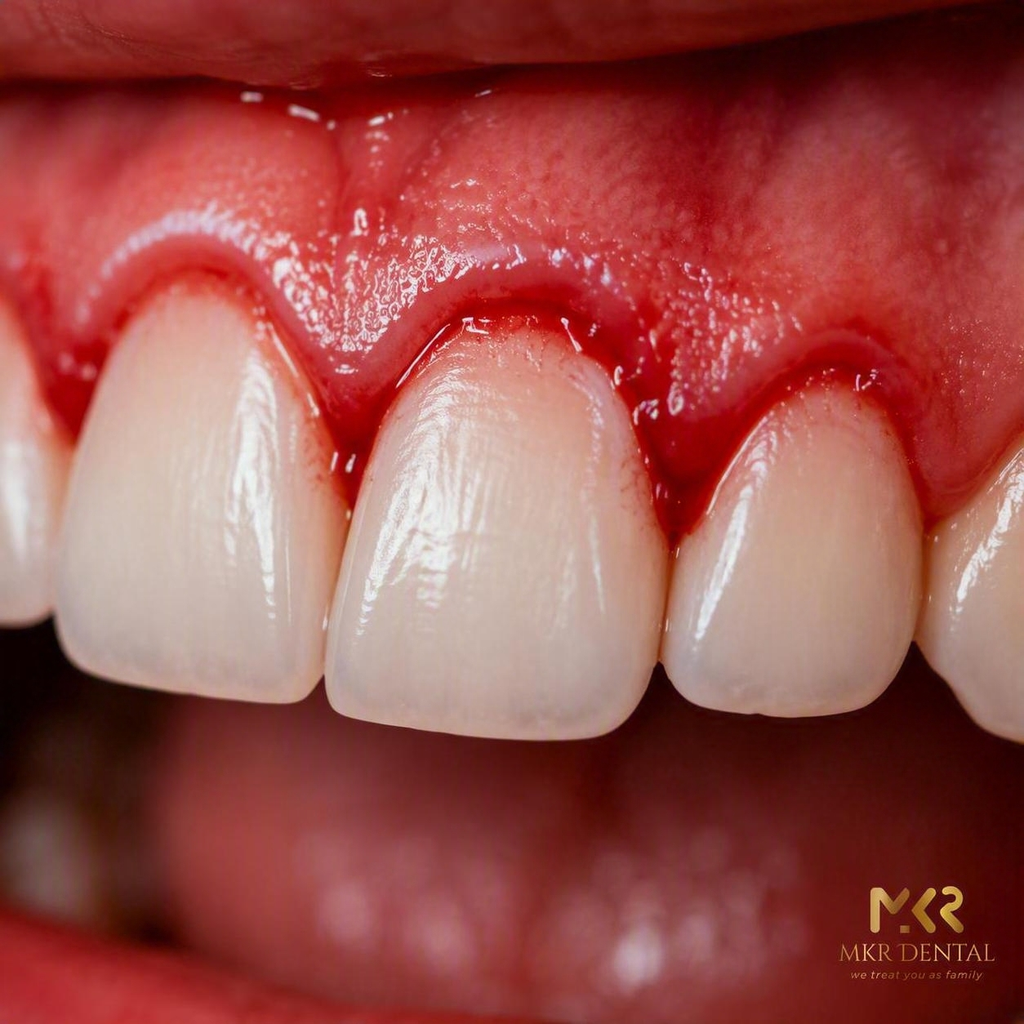Bleeding gums due to gum disease
