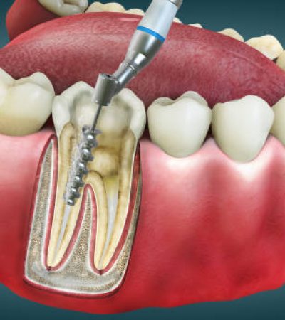 4D Root Canal Image