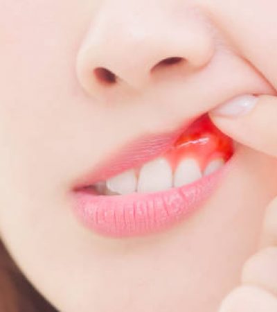 Closeup of asian female feel toothache redness and swelling due to periodontal disease