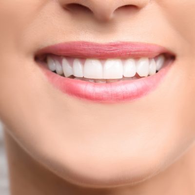 teeth-bonding